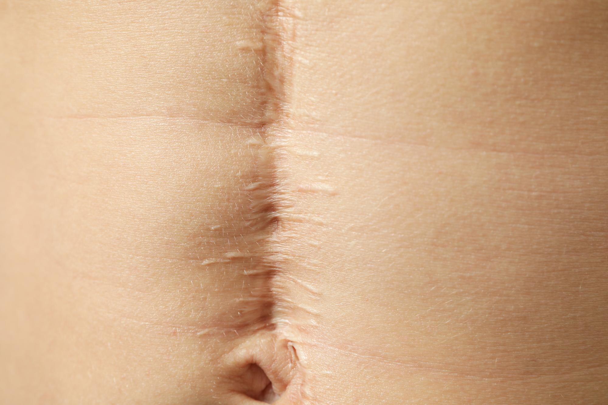 stomach-young-man-with-scar-close-up_185193-79790